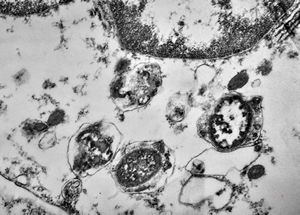 F,49y. | phagocytosed microbes - purulent meningitis